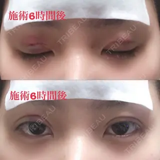 0日目の経過画像（3枚目）