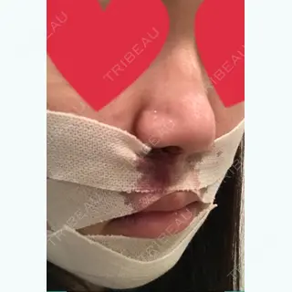 1日目の経過画像（3枚目）