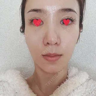 18日目の経過画像（2枚目）