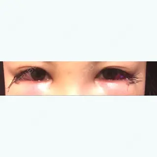 1日目の経過画像（2枚目）