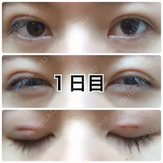 1日目の経過画像（1枚目）