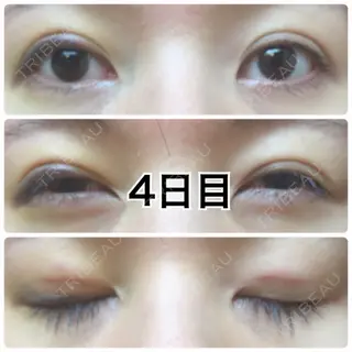 4日目の経過画像（1枚目）