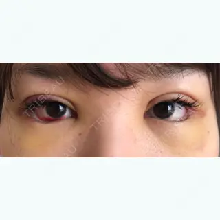 3日目の経過画像（1枚目）