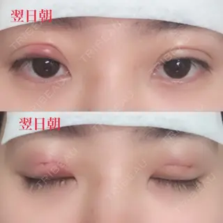 1日目の経過画像（1枚目）