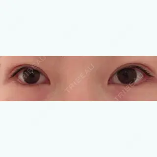 3日目の経過画像（3枚目）