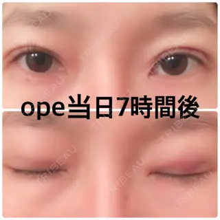 0日目の経過画像（1枚目）