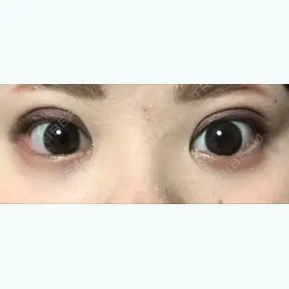 33日目の経過画像（1枚目）