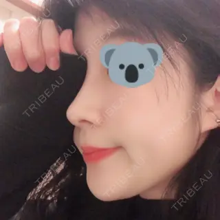 31日目の経過画像（2枚目）