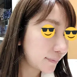 29日目の経過画像（3枚目）