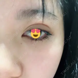 0日目の経過画像（2枚目）