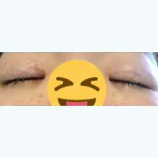 29日目の経過画像（3枚目）