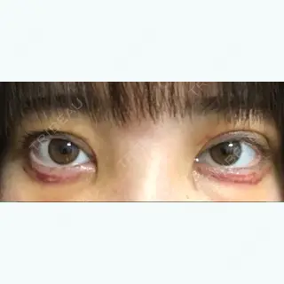 5日目の経過画像（1枚目）