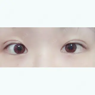 2日目の経過画像（1枚目）