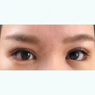 6日目の経過画像（3枚目）