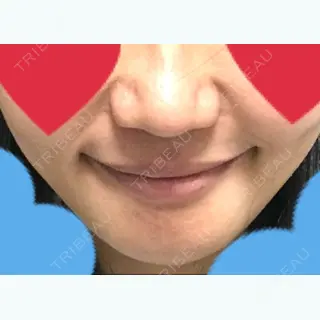 5日目の経過画像（3枚目）