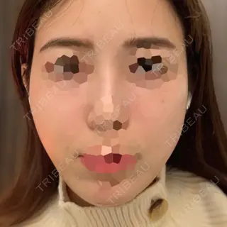 5日目の経過画像（1枚目）