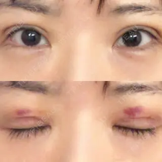 5日目の経過画像（1枚目）
