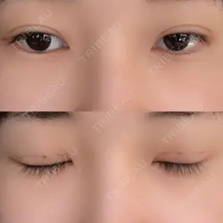 5日目の経過画像（1枚目）