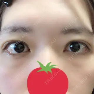 5日目の経過画像（1枚目）
