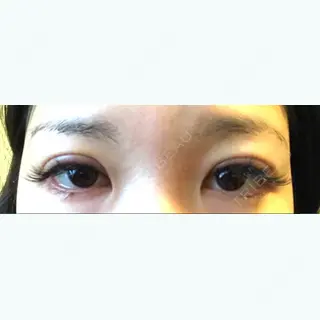 1日目の経過画像（1枚目）
