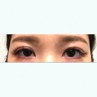 1日目の経過画像（1枚目）