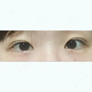 6日目の経過画像（1枚目）