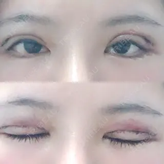 2日目の経過画像（1枚目）