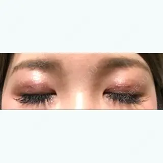 2日目の経過画像（2枚目）