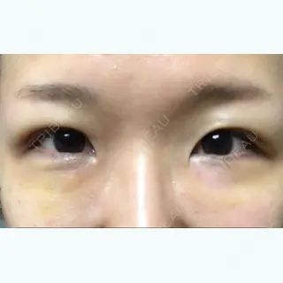 5日目の経過画像（2枚目）