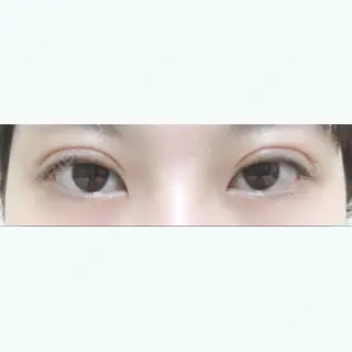 6日目の経過画像（1枚目）