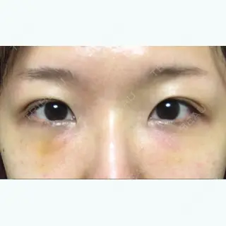 6日目の経過画像（2枚目）