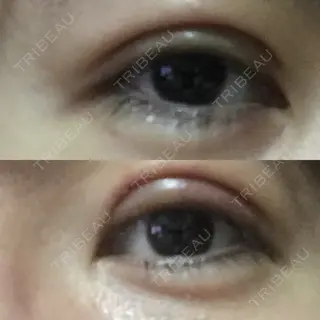 2日目の経過画像（1枚目）