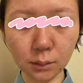 3日目の経過画像（1枚目）