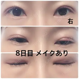 8日目の経過画像（1枚目）