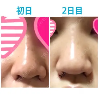 1日目の経過画像（3枚目）