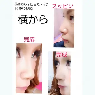 20日目の経過画像（2枚目）