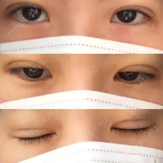 2日目の経過画像（1枚目）