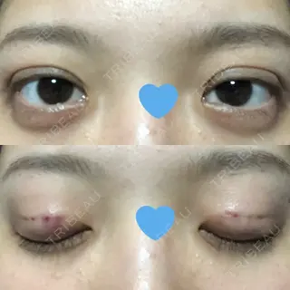 0日目の経過画像（1枚目）