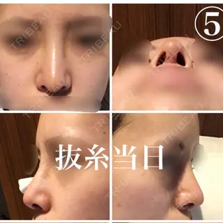 6日目の経過画像（1枚目）