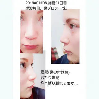 21日目の経過画像（1枚目）