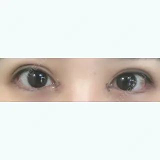 3日目の経過画像（1枚目）