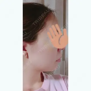 11日目の経過画像（2枚目）