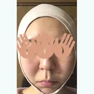 25日目の経過画像（1枚目）