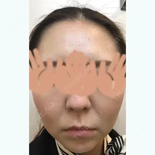26日目の経過画像（1枚目）