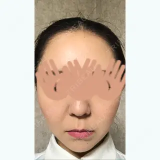 28日目の経過画像（1枚目）
