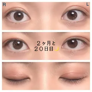 81日目の経過画像（1枚目）