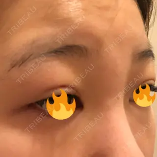 1日目の経過画像（2枚目）