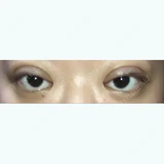 0日目の経過画像（1枚目）