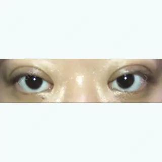2日目の経過画像（2枚目）
