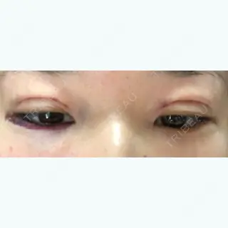 1日目の経過画像（1枚目）